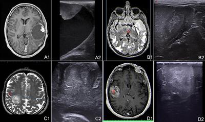 Advanced Ultrasound Imaging in Glioma Surgery: Beyond Gray-Scale B-mode